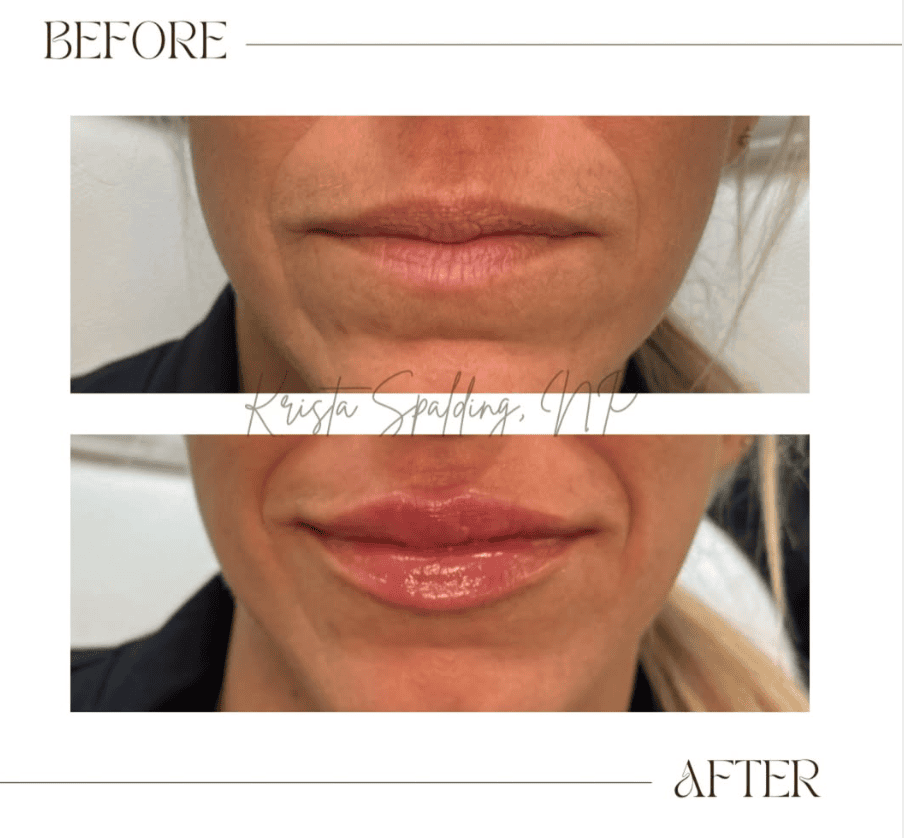 Jeuveau Treatment result