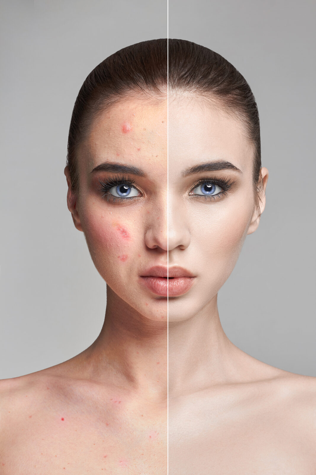 Acne & Acne Scars