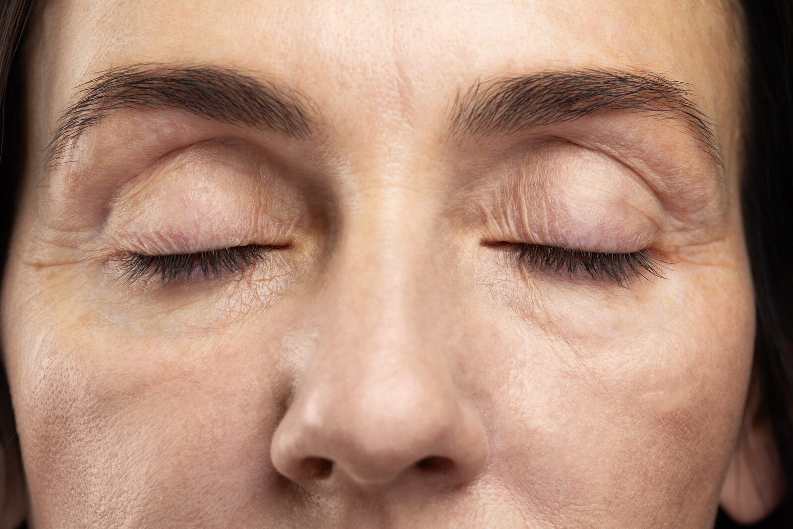 Under-Eye Hollows & Dark Circles