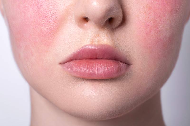 Rosacea & Redness
