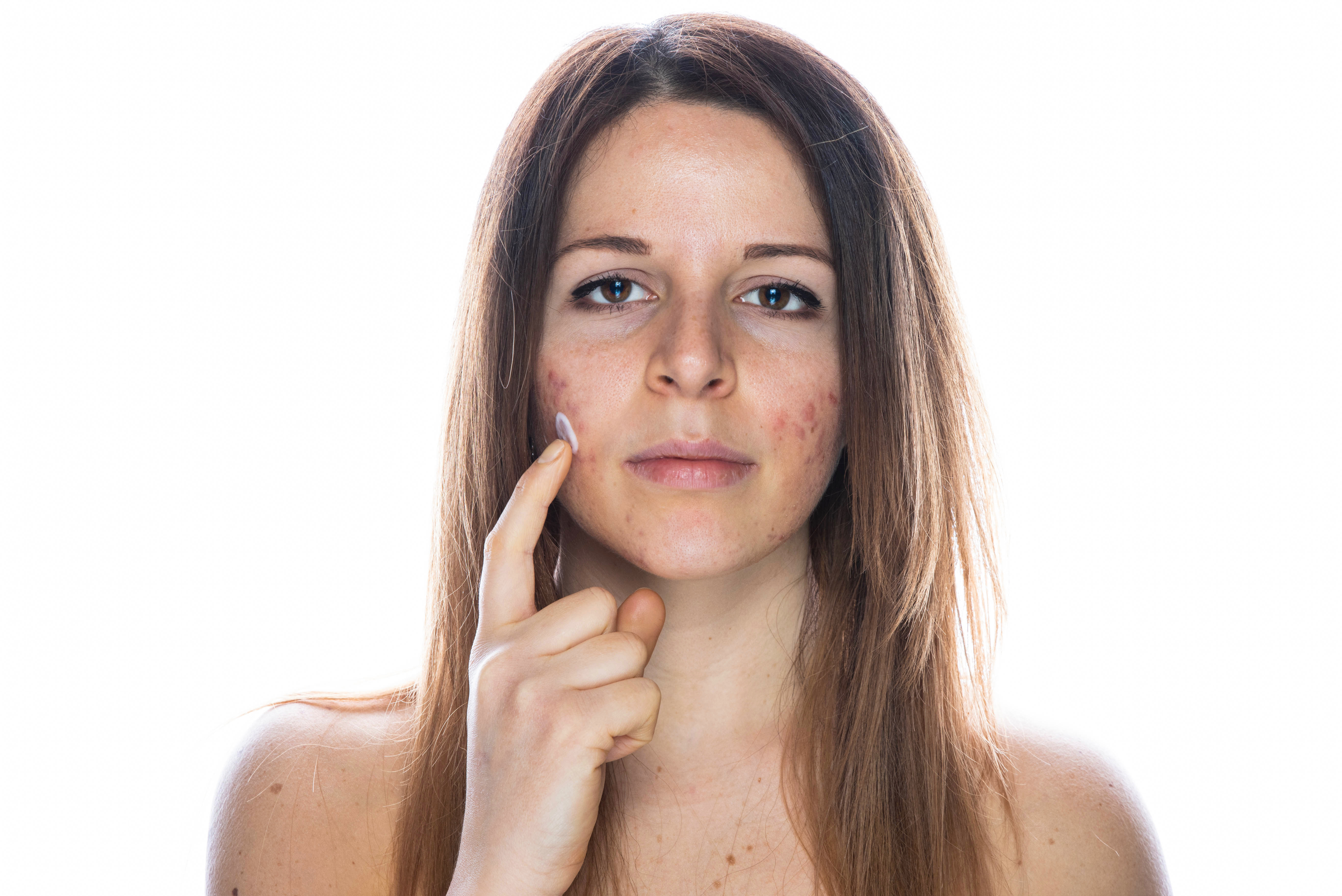 Uneven Skin Tone & Texture