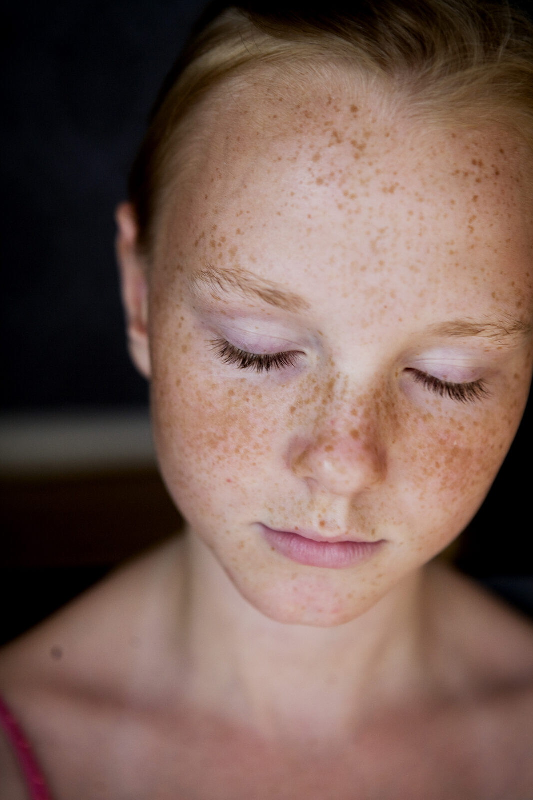 Sun Damage & Pigmentation