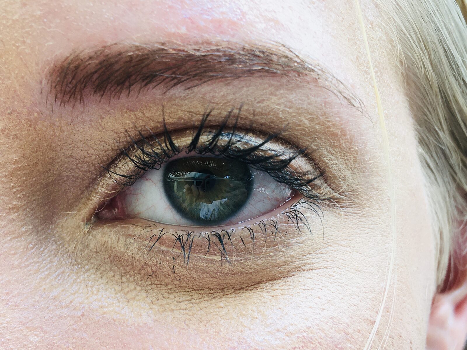 PRP (Platelet-Rich Plasma)